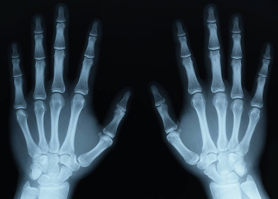 X-Ray, Hands