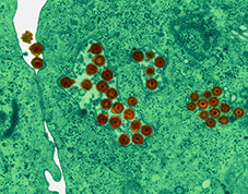 Herpes Simplex Virus (HSV-2, DNA virus)
