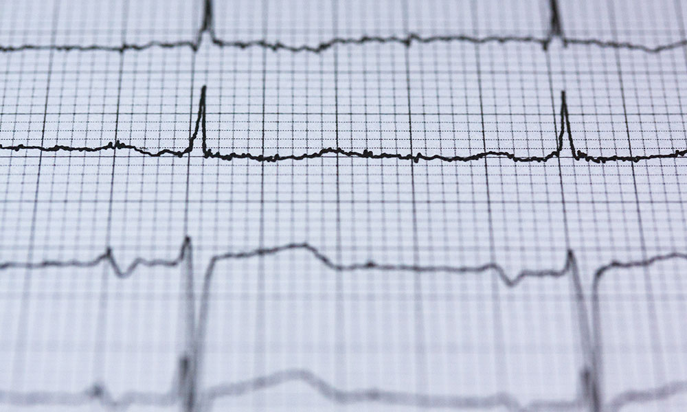 EKG/Heart Rate graph